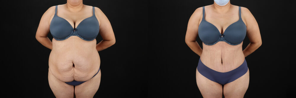 Tummy Tuck case #7464