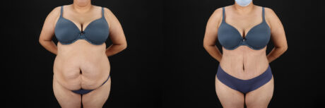 Tummy Tuck case #7464