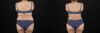 Tummy Tuck case #7464 slider thumbnail