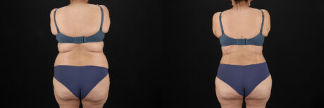 Tummy Tuck case #7464