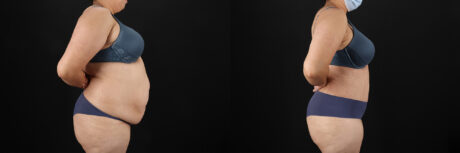 Tummy Tuck case #7464