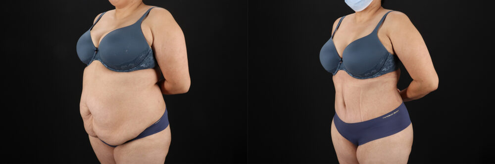 Tummy Tuck case #7464