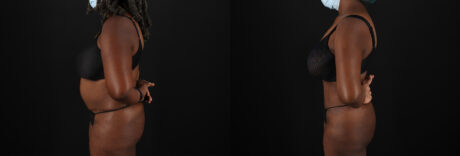 Brazilian Butt Lift case #5271