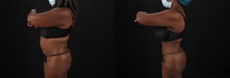 Brazilian Butt Lift case #5271