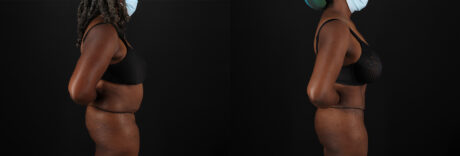 Brazilian Butt Lift case #5271