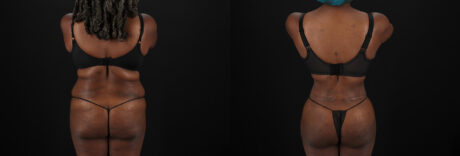 Brazilian Butt Lift case #5271