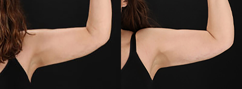 Tummy Tuck case #7465