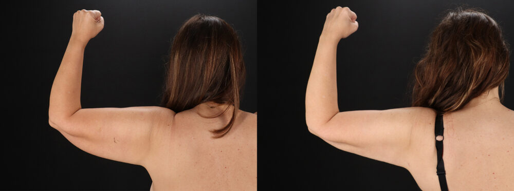 Tummy Tuck case #7465