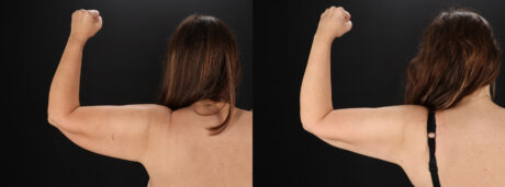 Tummy Tuck case #7465