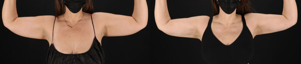 Tummy Tuck case #7465