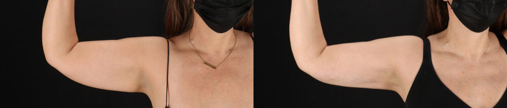 Tummy Tuck case #7465