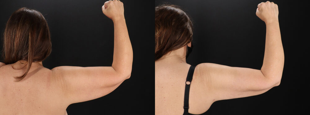 Tummy Tuck case #7465