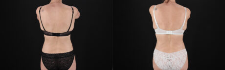 Tummy Tuck case #7622