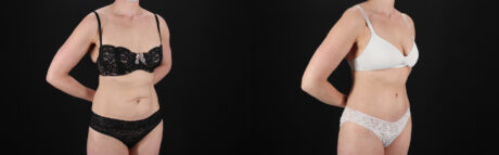 Tummy Tuck case #7622