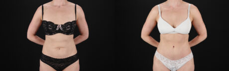 Tummy Tuck case #7622