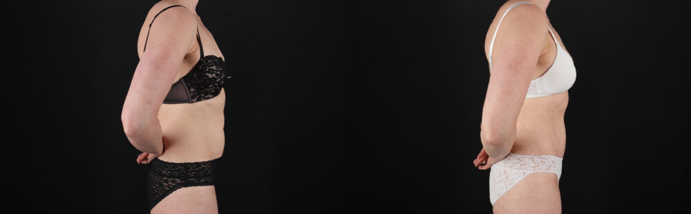 Tummy Tuck case #7622