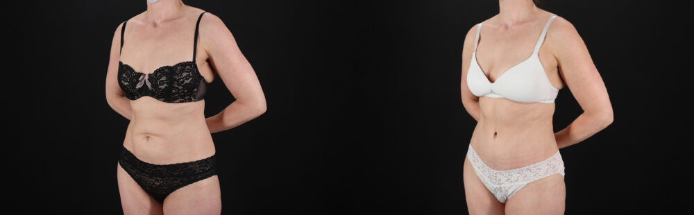 Tummy Tuck case #7622