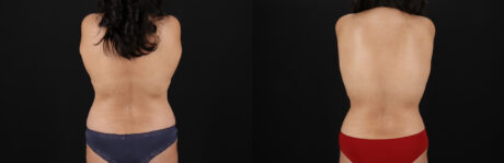 Tummy Tuck case #7626