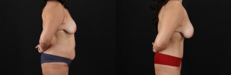 Tummy Tuck case #7626