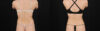 Liposuction case #6119 slider thumbnail