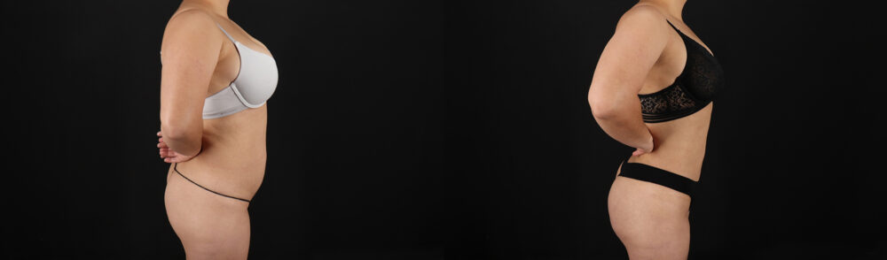 Brazilian Butt Lift case #5390