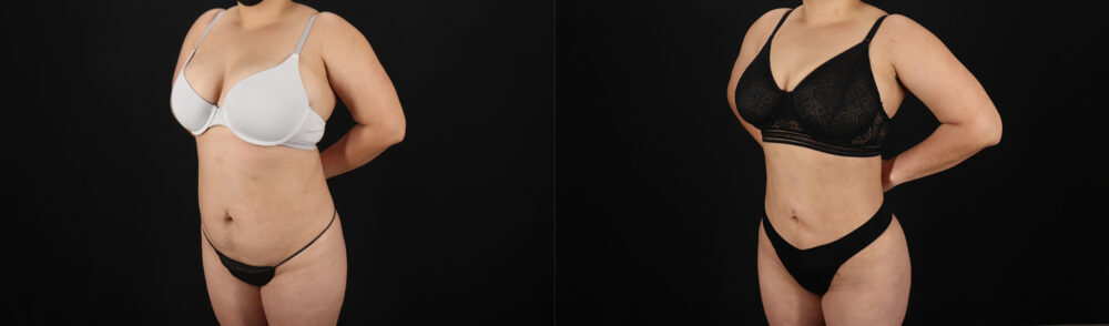 Brazilian Butt Lift case #5390