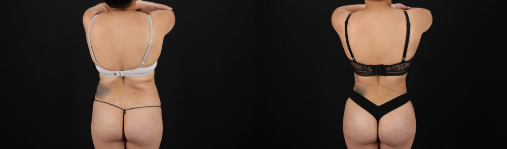 Brazilian Butt Lift case #5390