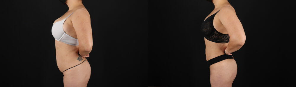 Brazilian Butt Lift case #5390