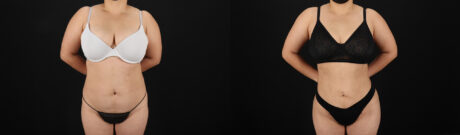 Brazilian Butt Lift case #5390