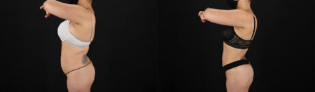 Brazilian Butt Lift case #5390