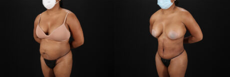 Tummy Tuck case #7468