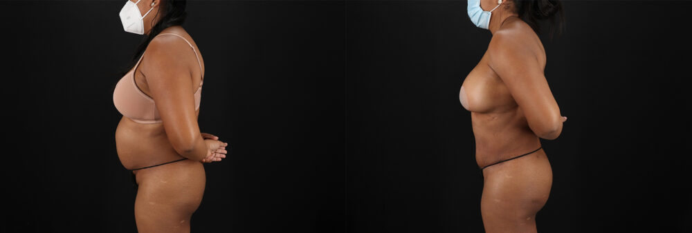 Tummy Tuck case #7468