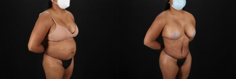 Tummy Tuck case #7468