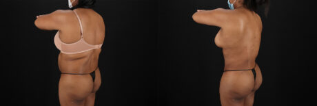 Tummy Tuck case #7468