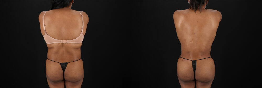 Tummy Tuck case #7468