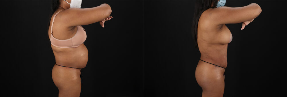 Tummy Tuck case #7468