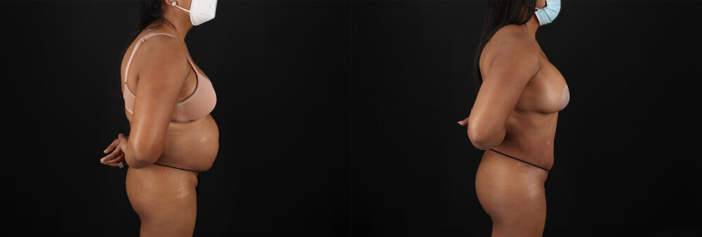 Tummy Tuck case #7468