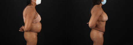 Tummy Tuck case #7468