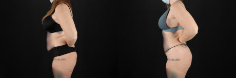 Brazilian Butt Lift case #5392