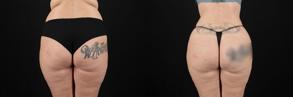 Brazilian Butt Lift case #5392