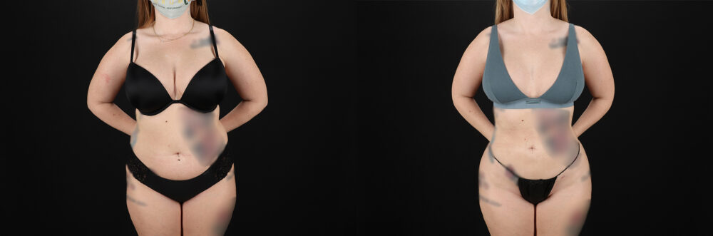 Brazilian Butt Lift case #5392