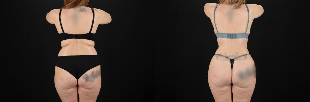 Brazilian Butt Lift case #5392