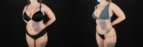 Brazilian Butt Lift case #5392