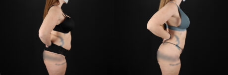 Brazilian Butt Lift case #5392