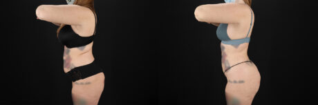 Brazilian Butt Lift case #5392