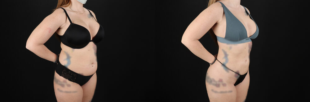 Brazilian Butt Lift case #5392