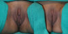 Labiaplasty case #5775 slider thumbnail