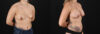 Breast Augmentation case #6408 slider thumbnail