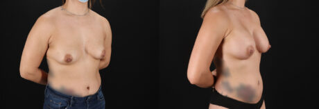 Breast Augmentation case #6408