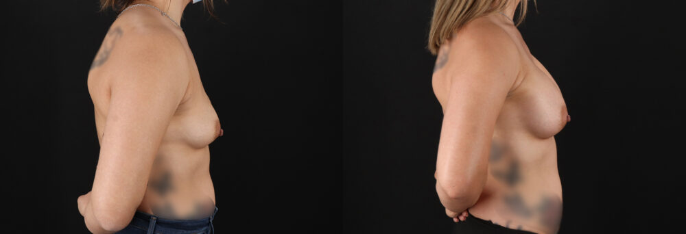 Breast Augmentation case #6408